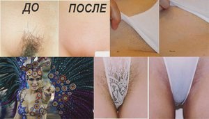 Бразильское бикини эпиляция в домашних условиях и в салоне () Бразильское бикини эпиляция в домашних условиях и в салоне