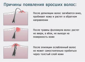 Бразильское бикини эпиляция в домашних условиях и в салоне () Бразильское бикини эпиляция в домашних условиях и в салоне