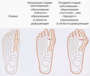 Шишка на ноге у большого пальца - причины, лечение () Шишка на ноге у большого пальца - причины, лечение