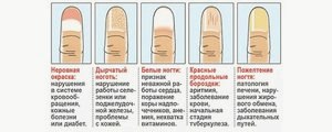 Слоятся ногти на руках: причины, лечение () Слоятся ногти на руках: причины, лечение