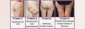 Антицеллюлитный массаж бедер и ягодиц в домашних условиях () Антицеллюлитный массаж бедер и ягодиц в домашних условиях