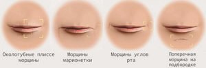 Морщины вокруг рта - как убрать их в домашних условиях () Морщины вокруг рта - как убрать их в домашних условиях